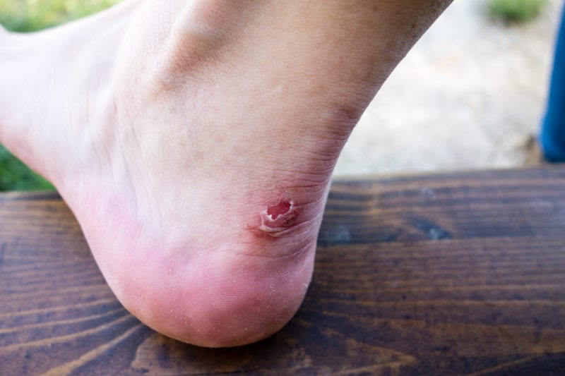 person with an open blister on the heel