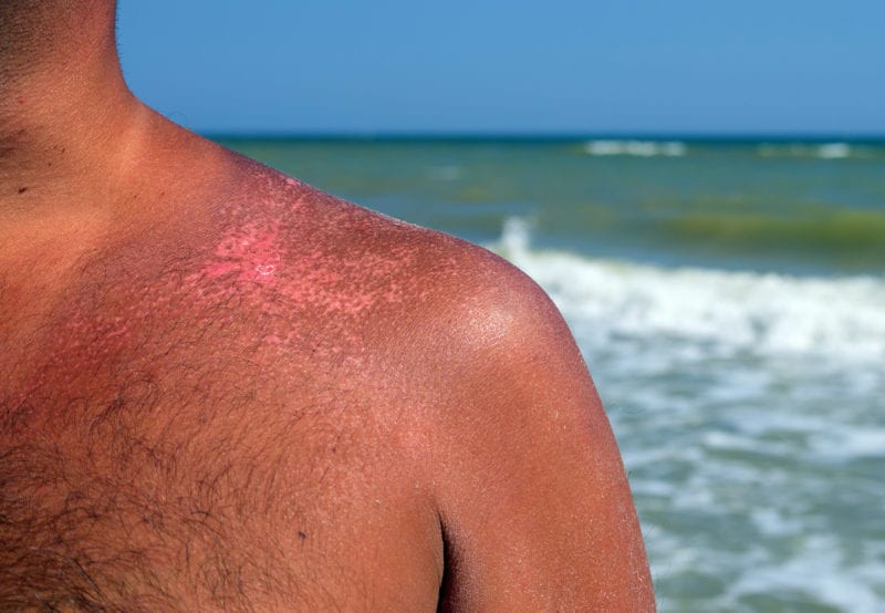 how to prevent chafing at the beach